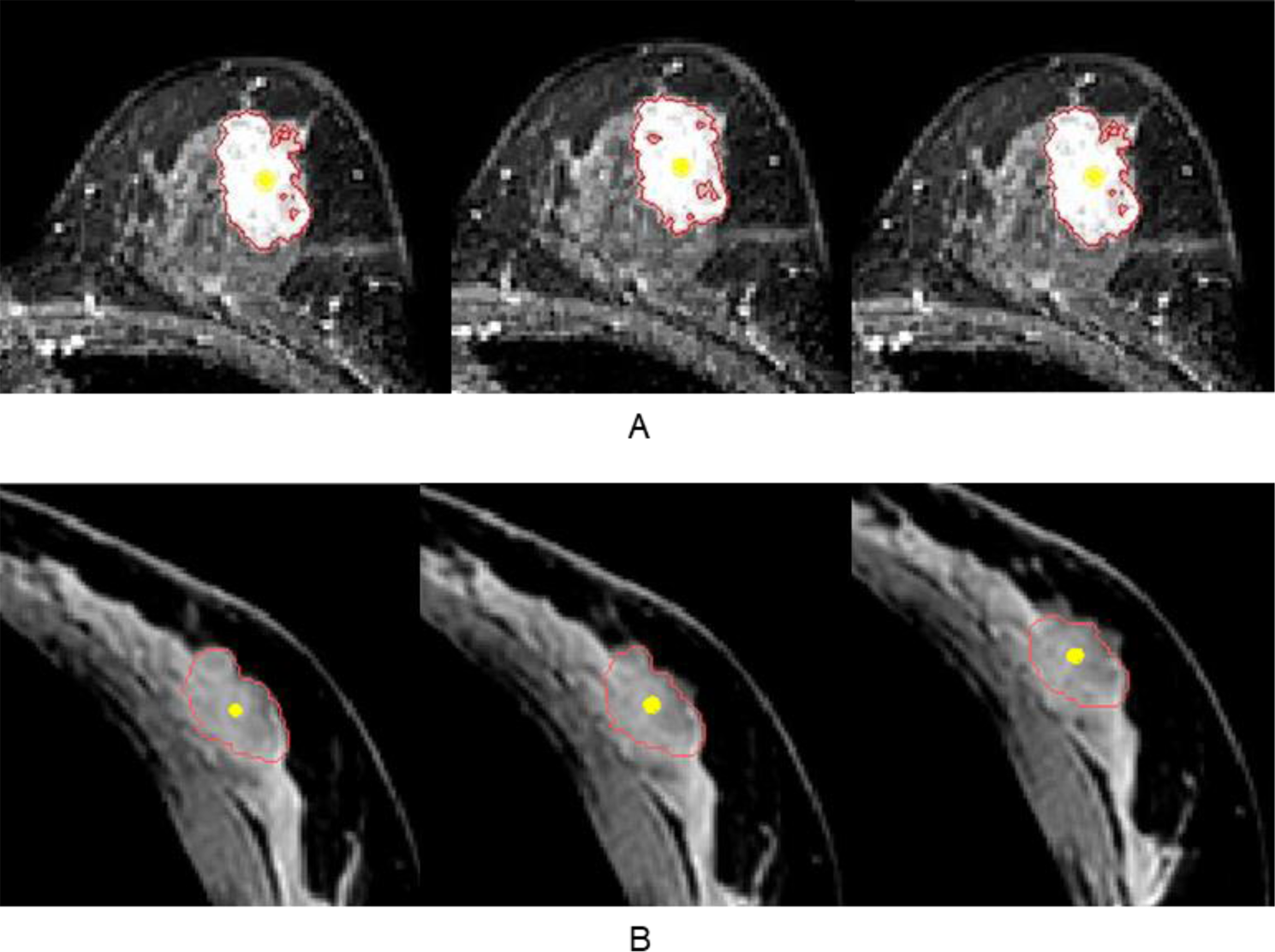 Assessment of breast displacement. MRI transverse view of natural