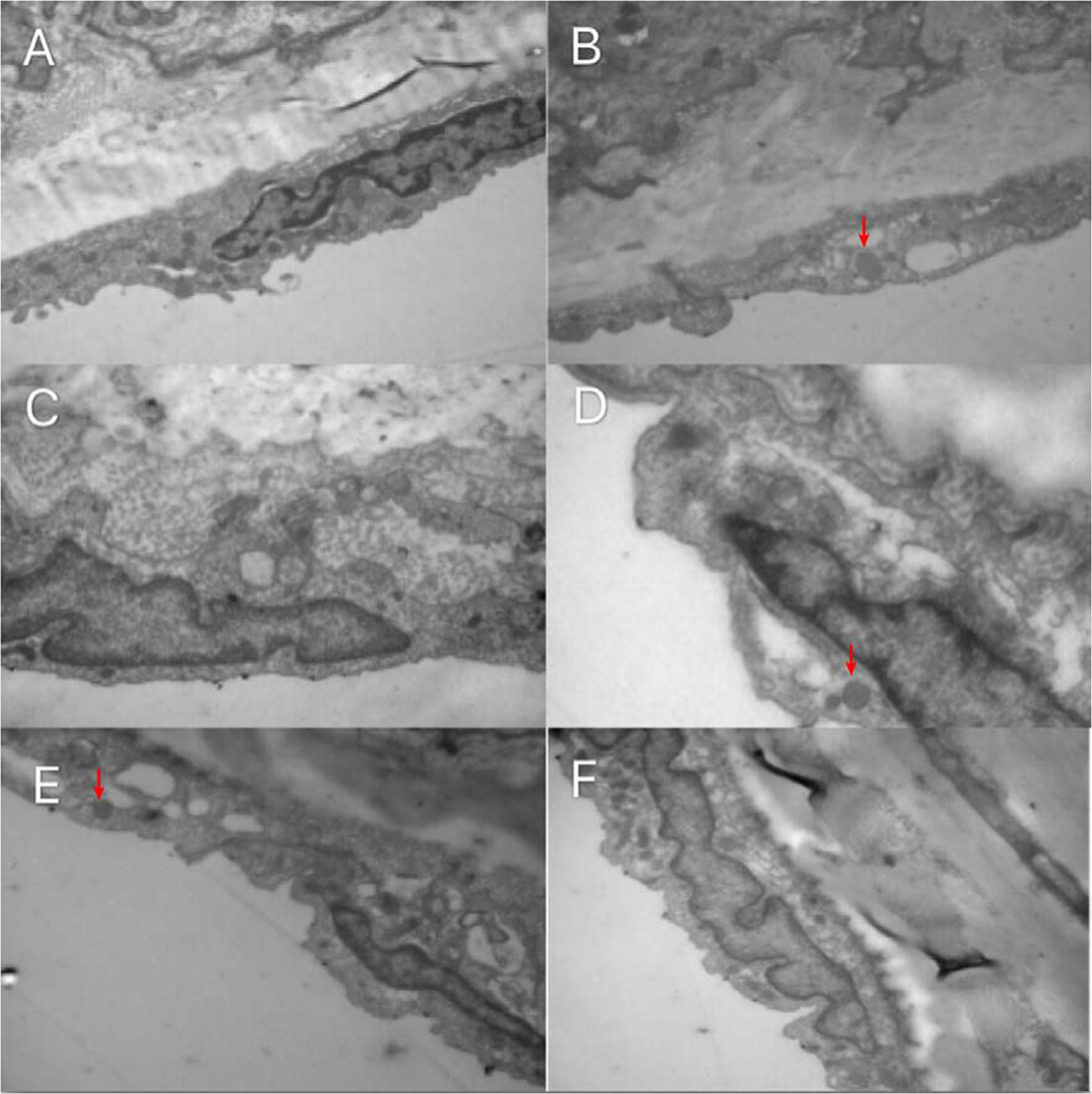 Study On The Relationship Between Hyperthyroidism And Vascular Endothelial Cell Damage Scientific Reports