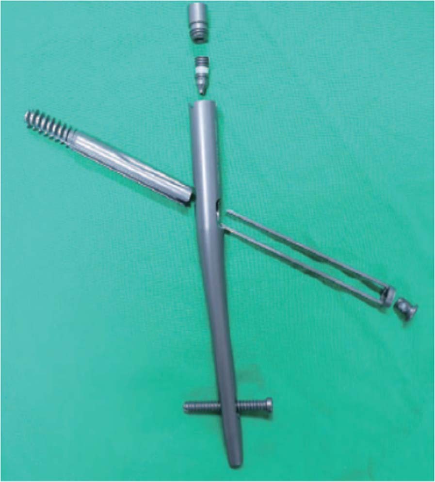 Gamma3 nail with U-Blade (RC) lag screw is effective with better surgical  outcomes in trochanteric hip fractures | Scientific Reports