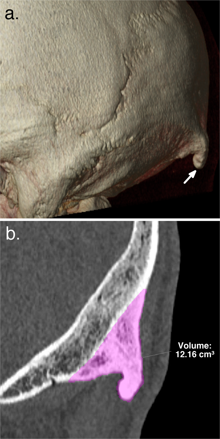 Enlarged External Occipital Protuberance In Young French Individuals Head Ct Stability In Prevalence Size And Type Between 11 And 19 Scientific Reports