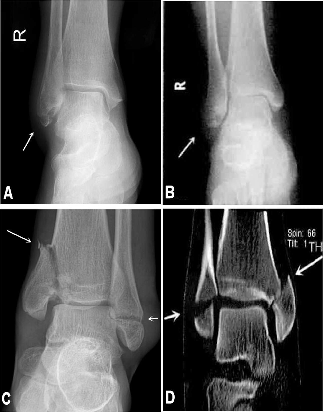 Radiographic analysis of adult ankle fractures using combined Danis-Weber  and Lauge-Hansen classification systems