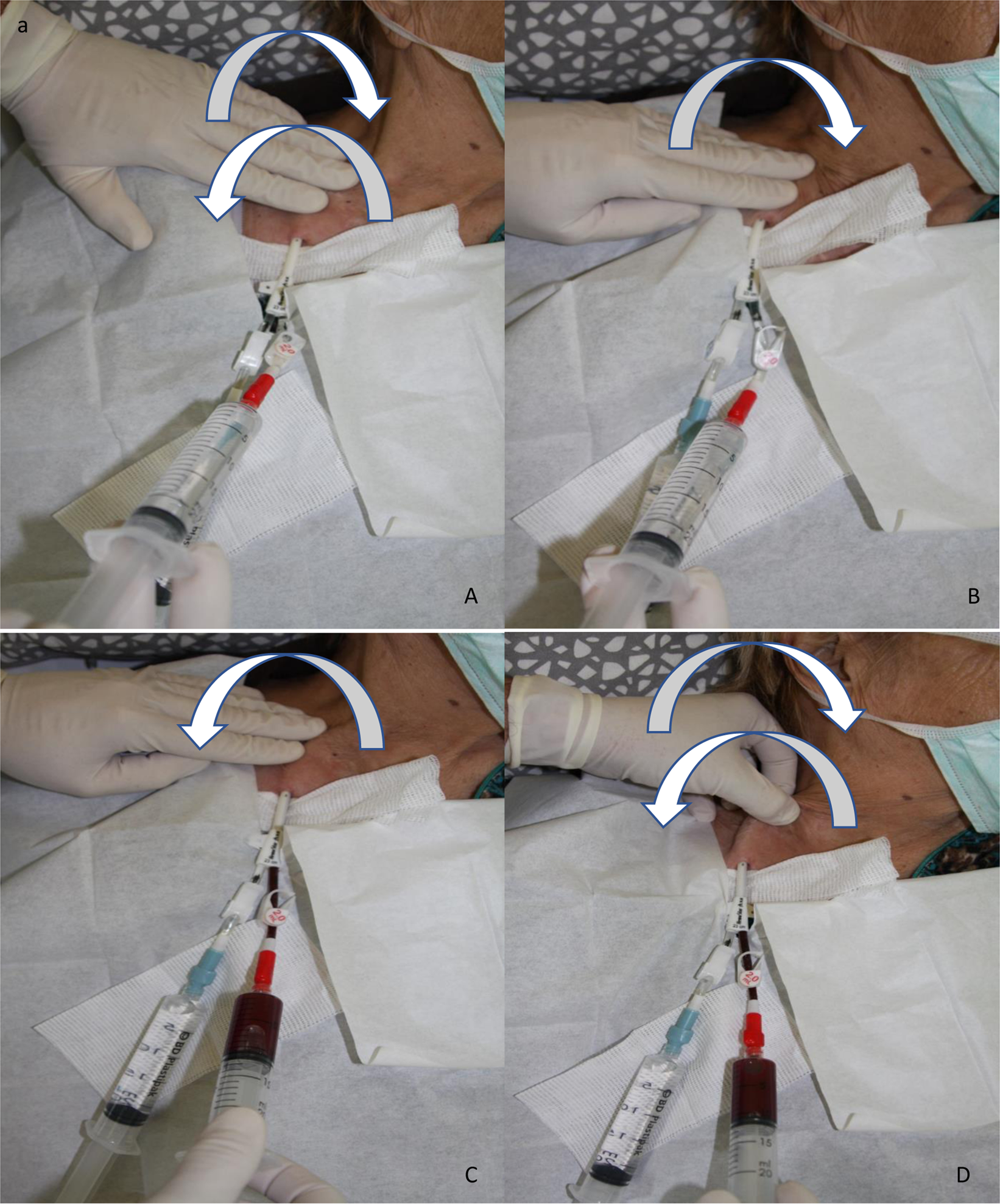 Non-invasive tunnelled catheter reposition (NTCR) A simple and safe method to restore central tunnelled catheter function for haemodialysis Scientific Reports