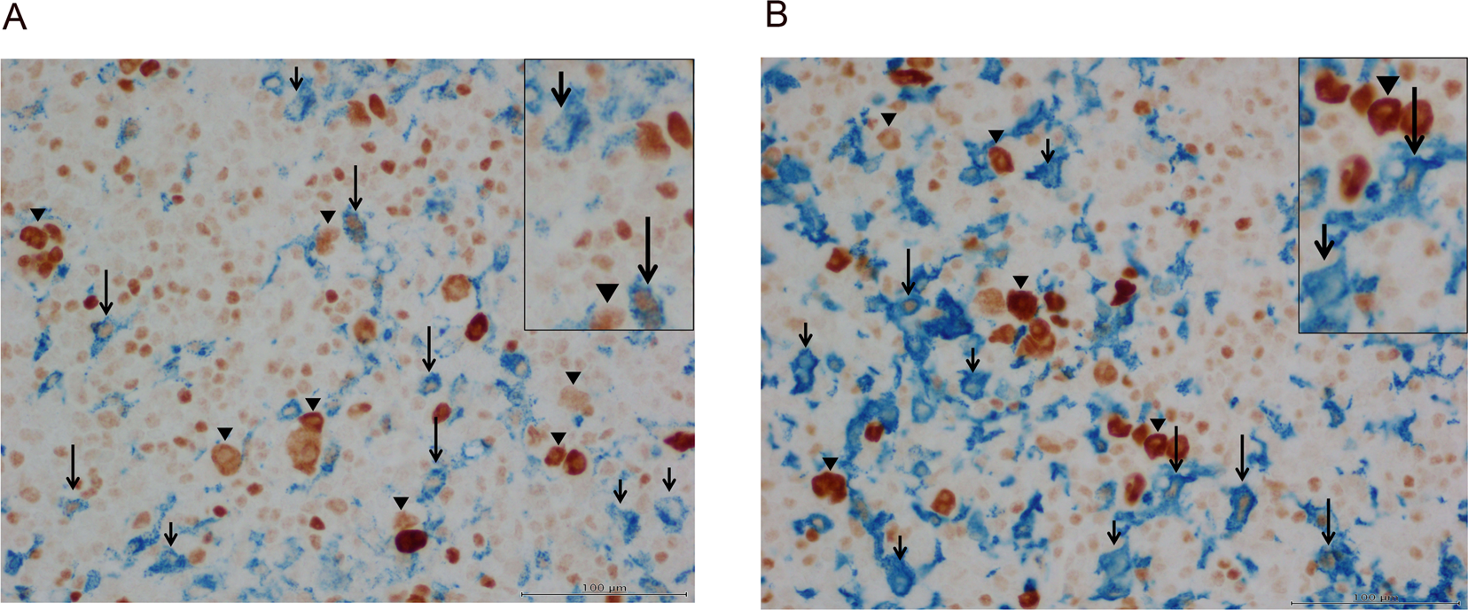 Tumor Associated Macrophages In Classical Hodgkin Lymphoma Hormetic Relationship To Outcome Scientific Reports