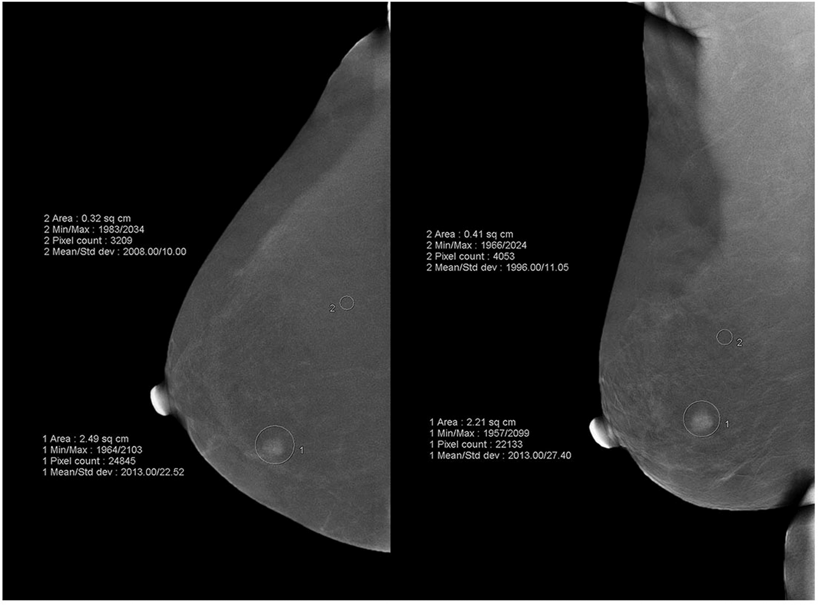 Quantitative Analysis Of Enhancement Intensity And Patterns On Contrast Enhanced Spectral Mammography Scientific Reports