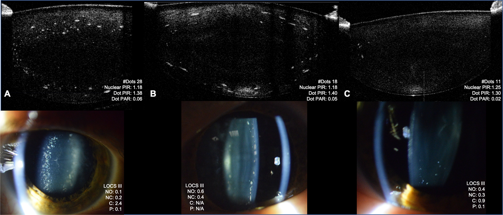 In-vivo anterior segment OCT imaging provides unique insight into cerulean  blue-dot opacities and cataracts in Down syndrome | Scientific Reports