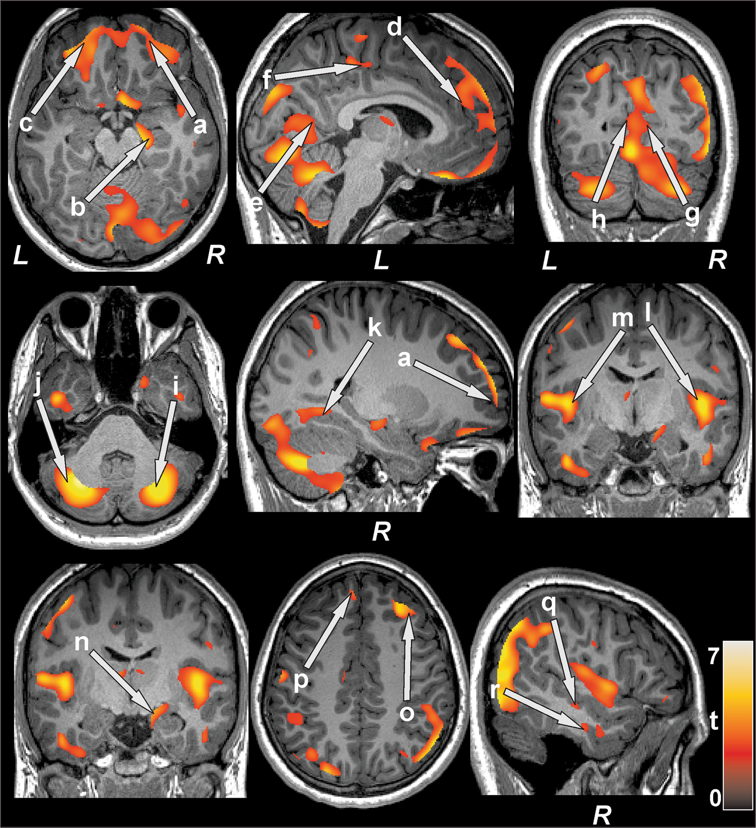 Regional Brain Gray Matter Changes in Patients with Type 2 Diabetes  Mellitus | Scientific Reports