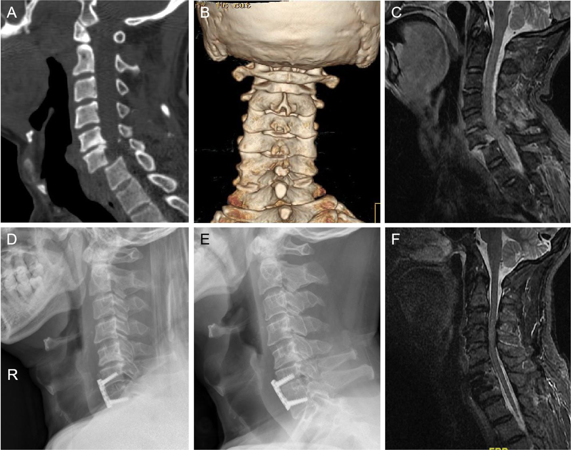 dislocated neck x ray