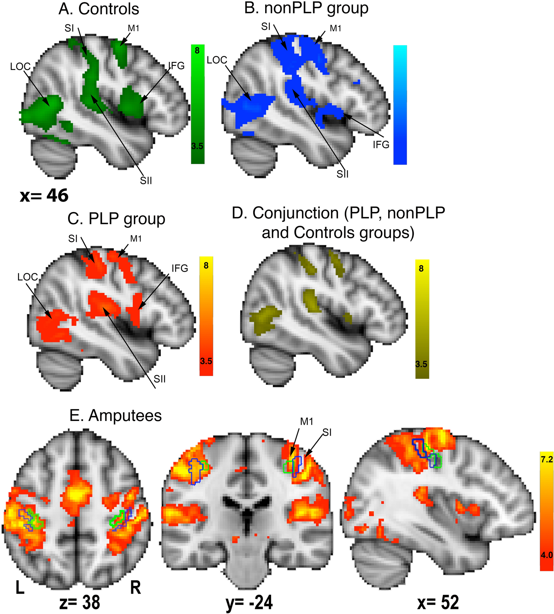 Assessment of cortical reorganization and preserved function in phantom  limb pain: a methodological perspective | Scientific Reports