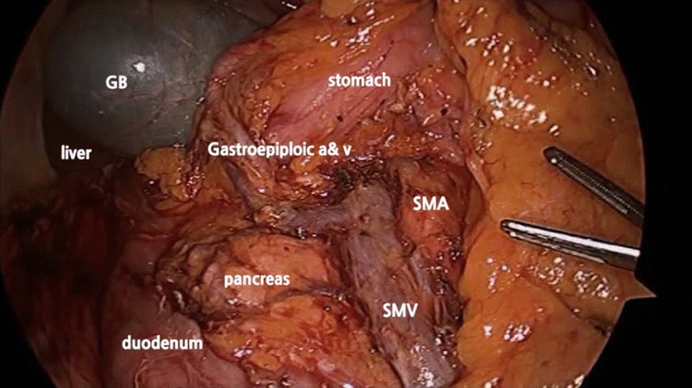 cancer colon laparoscopia