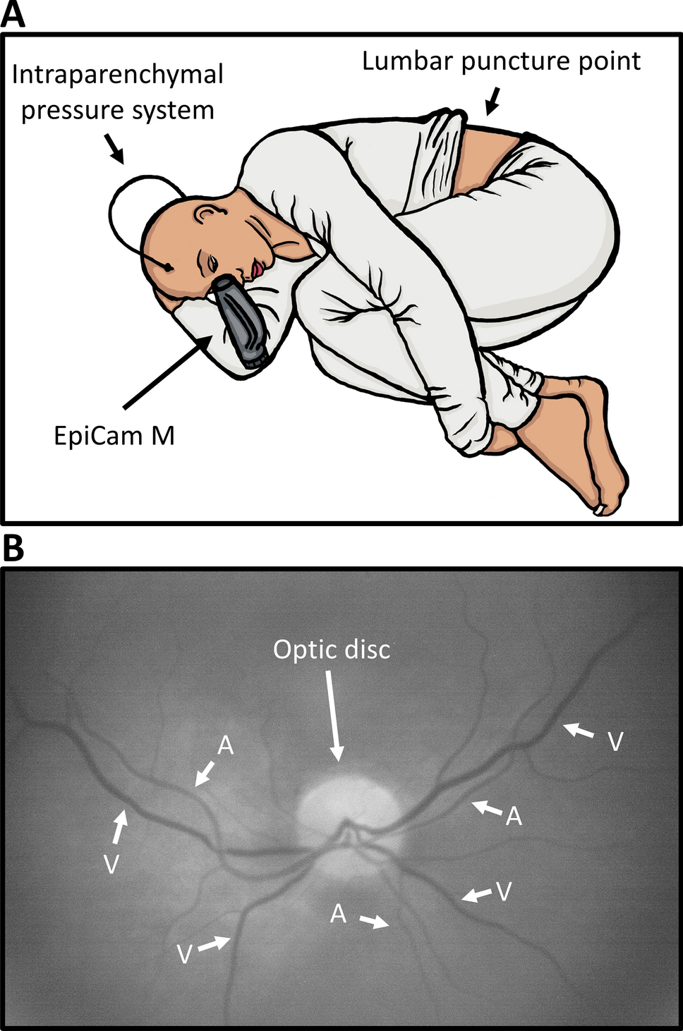 A Trial of Intracranial-Pressure Monitoring in Traumatic Brain Injury