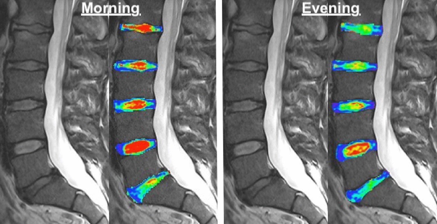 Diurnal T2-changes of the intervertebral discs of the entire spine and the  influence of weightlifting | Scientific Reports