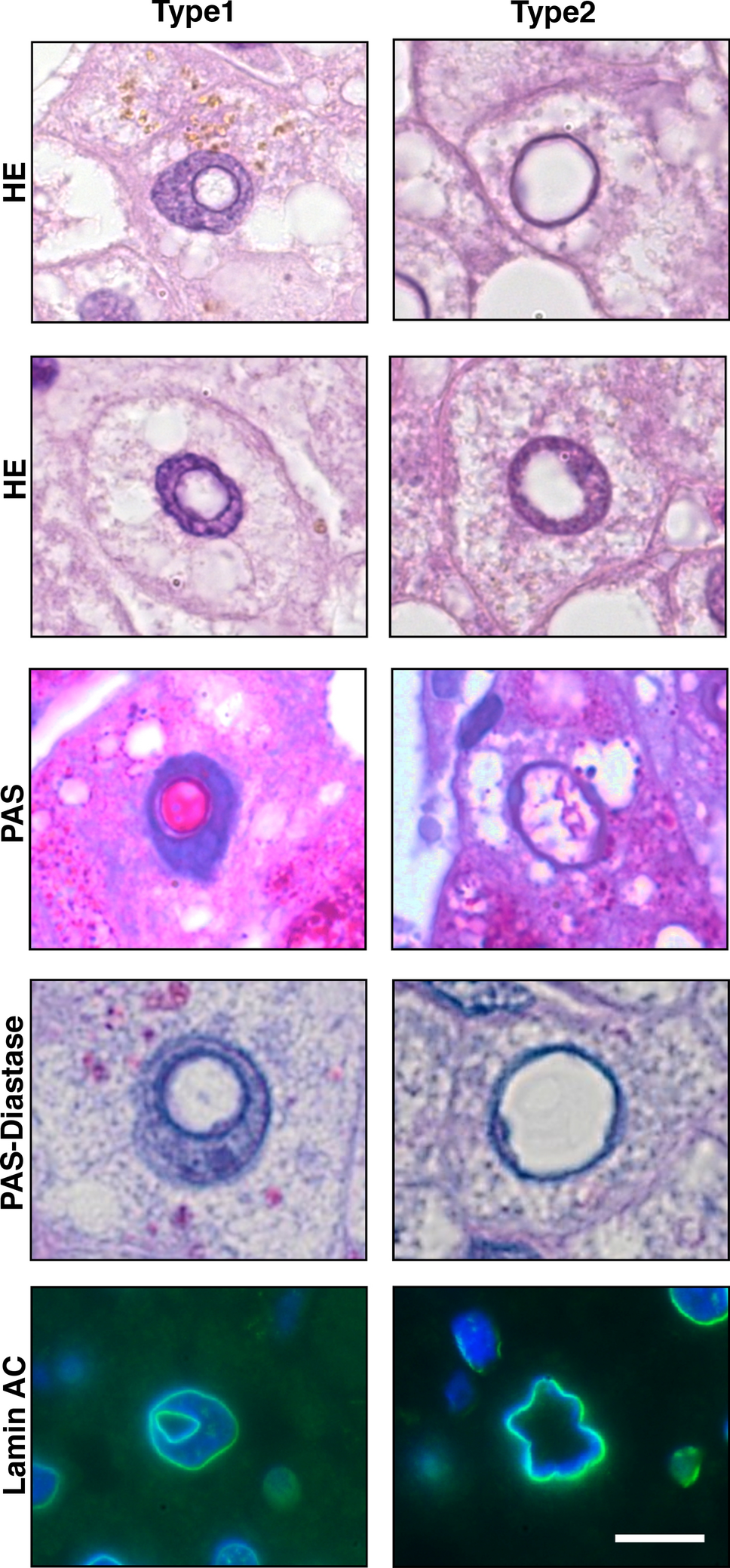 Characterization of two types of intranuclear hepatocellular inclusions in  NAFLD | Scientific Reports