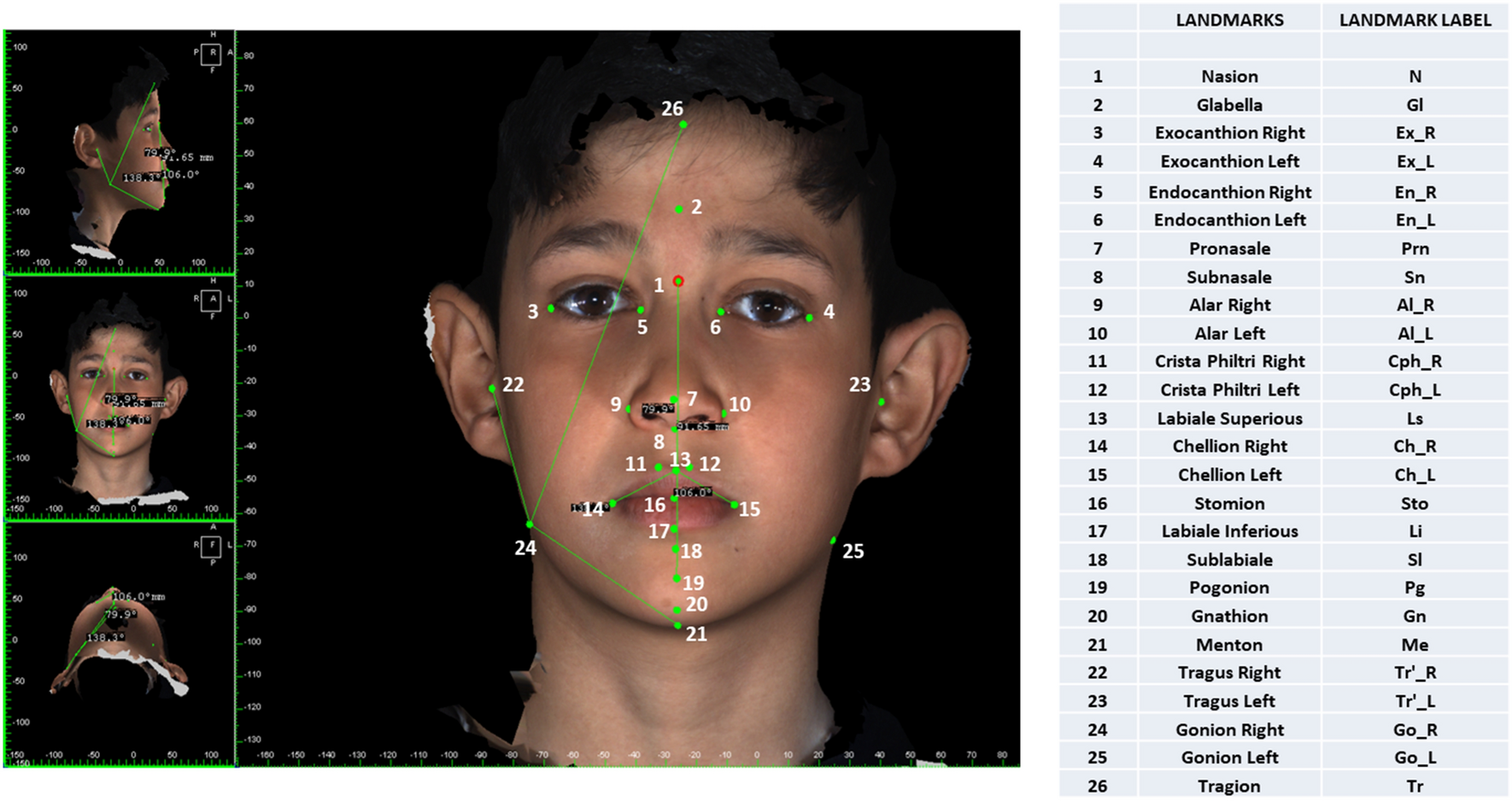 skeletal malocclusion