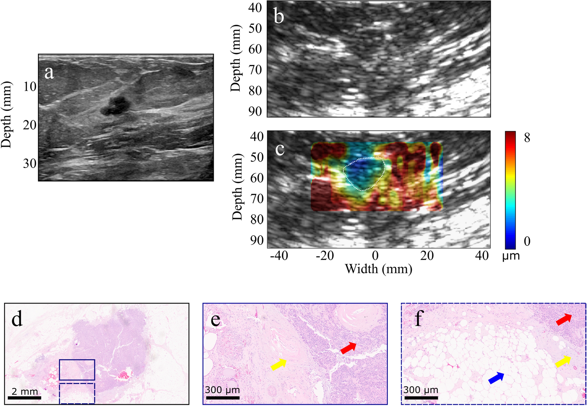 Harmonic motion imaging of human breast masses: an in vivo clinical  feasibility
