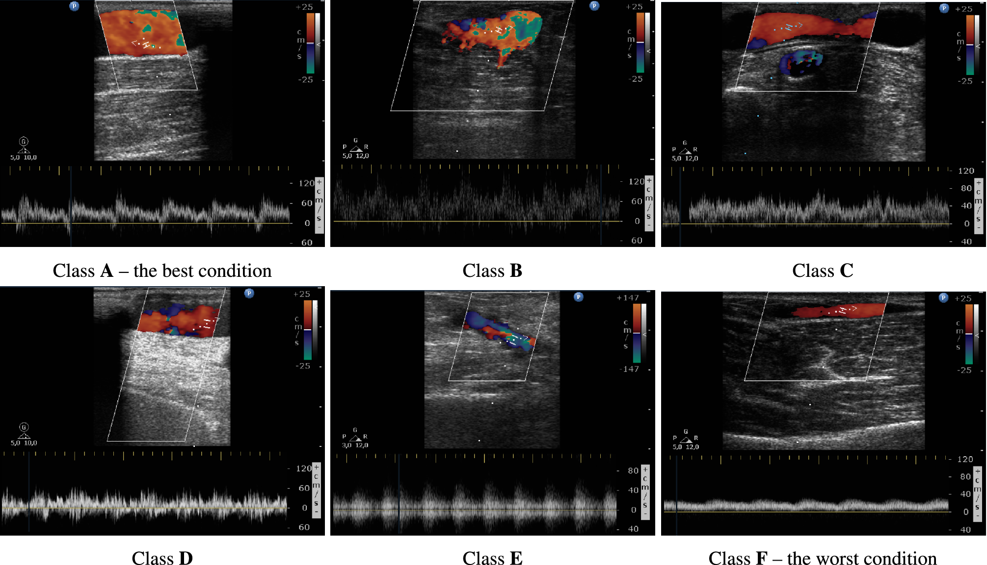 Doppler vascular mapping in Arterio Venous Fistula (AVF)