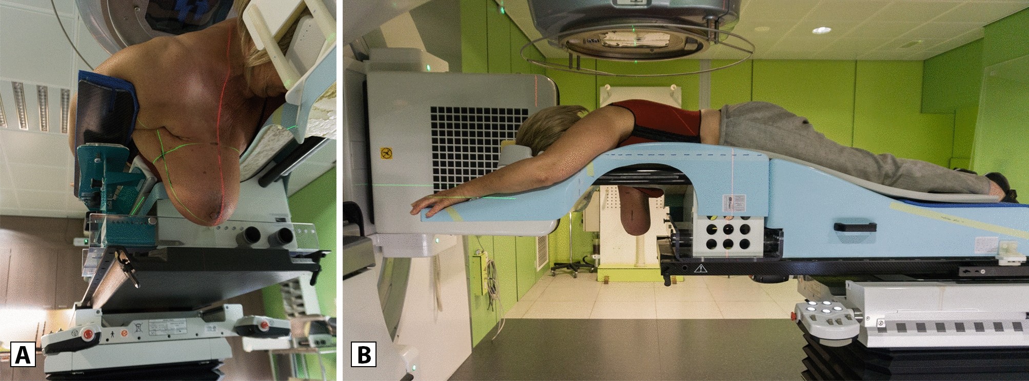Crawl positioning improves set-up precision and patient comfort in prone  whole breast irradiation