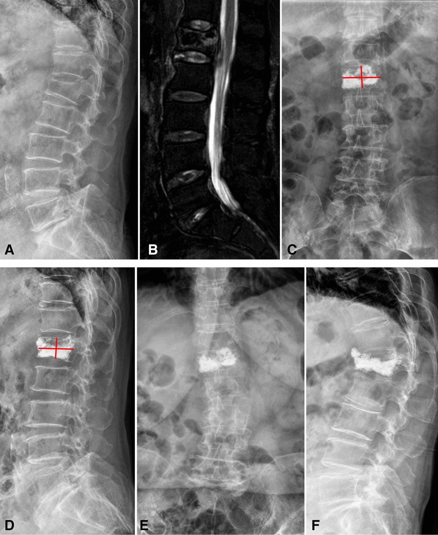 A Novel And Convenient Method To Evaluate Bone Cement Distribution  Following Percutaneous Vertebral Augmentation | Scientific Reports