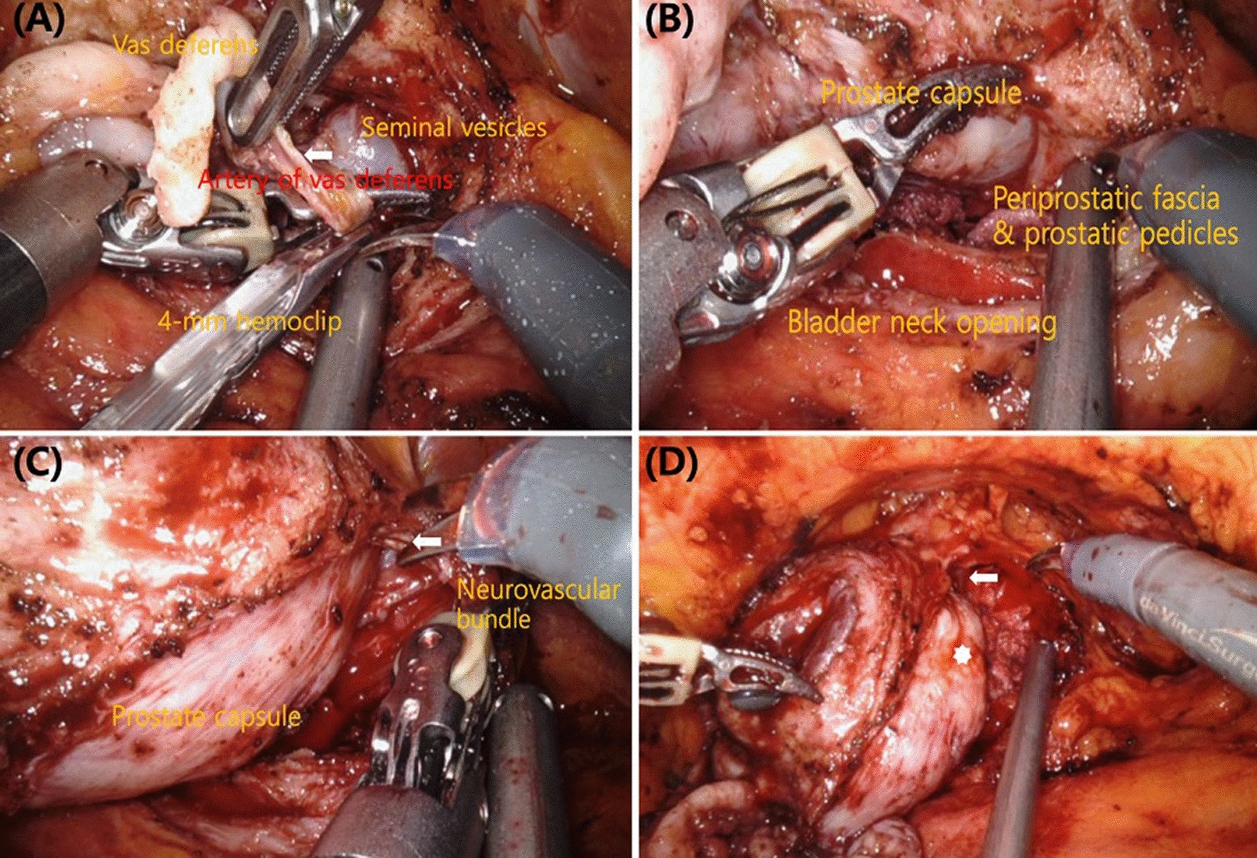 overvåge Juster damper Robot-assisted radical prostatectomy with clipless intrafascial  neurovascular bundle-sparing approach: surgical technique and one-year  functional and oncologic outcomes | Scientific Reports