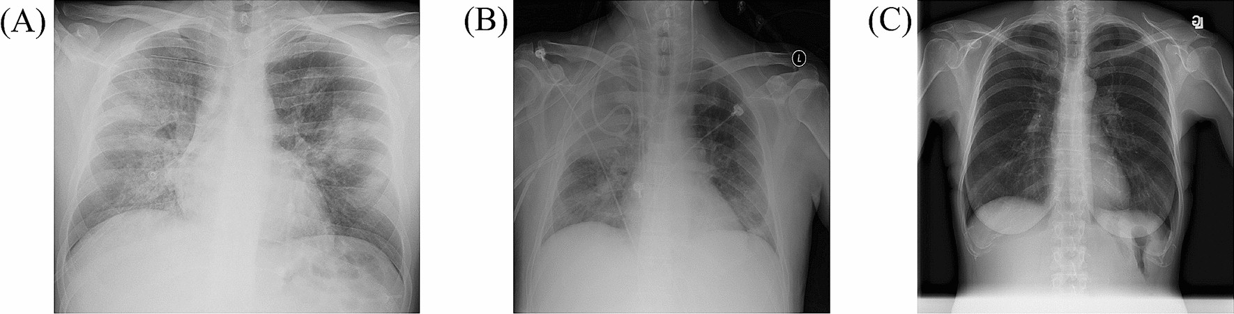 chest x ray pneumonia