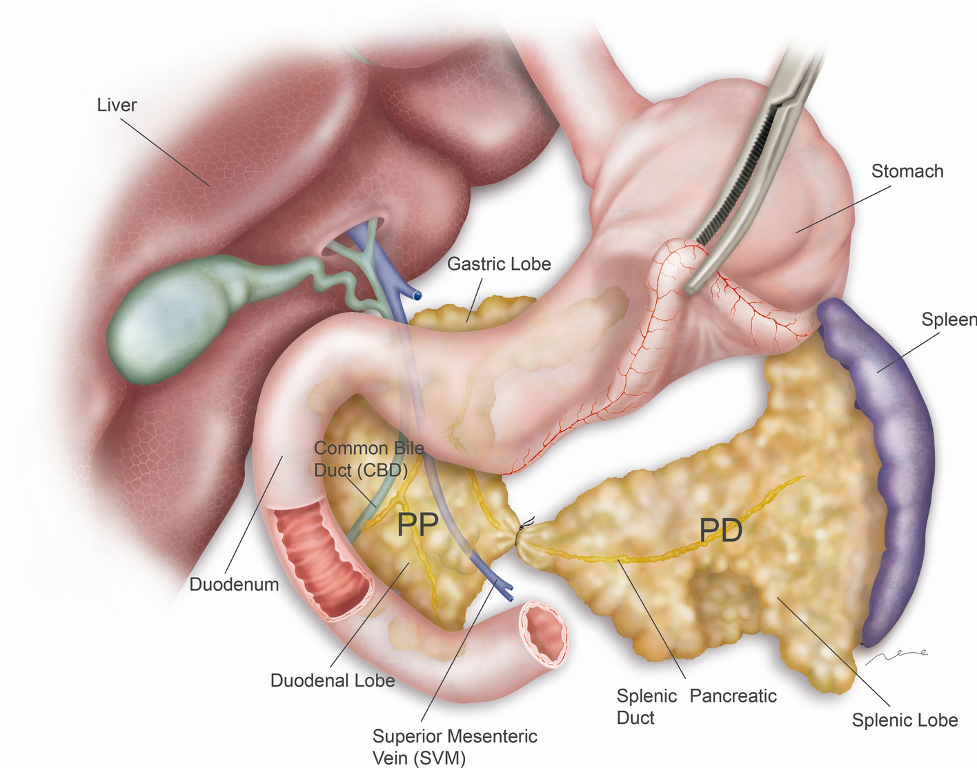 Pancreatic duct ligation reduces premalignant pancreatic lesions in a Kras  model of pancreatic adenocarcinoma in mice | Scientific Reports
