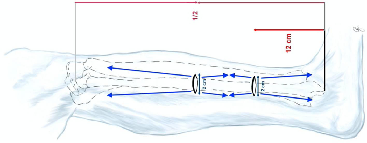 Dual-incision minimally invasive fasciotomy of the anterior and peroneal  compartments for chronic exertional compartment syndrome of the lower leg |  Scientific Reports