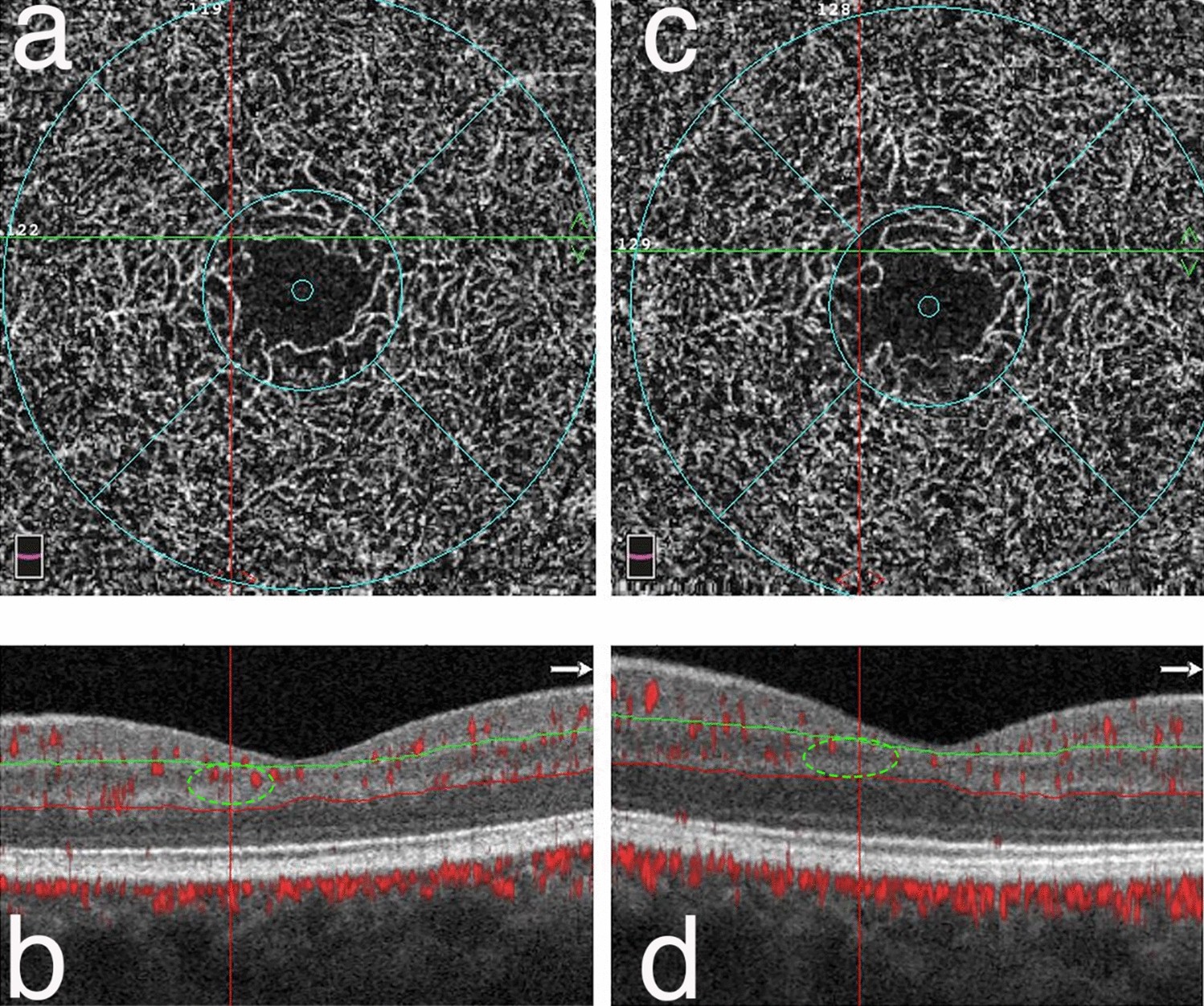 Microvascular Impairment As A Biomarker Of Diabetic Retinopathy Progression In The Long Term Follow Up In Type 1 Diabetes Scientific Reports