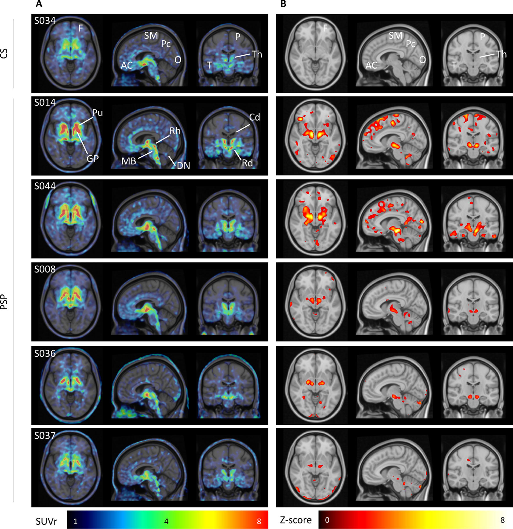Quien buffet Empleado 18F-THK5351 PET imaging in patients with progressive supranuclear palsy:  associations with core domains and diagnostic certainty | Scientific Reports