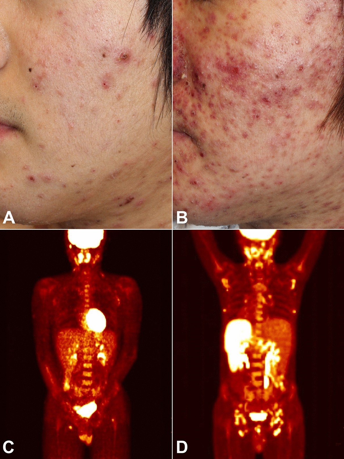 Hydroa vacciniforme-like lymphoproliferative disorder in Korea | Scientific  Reports