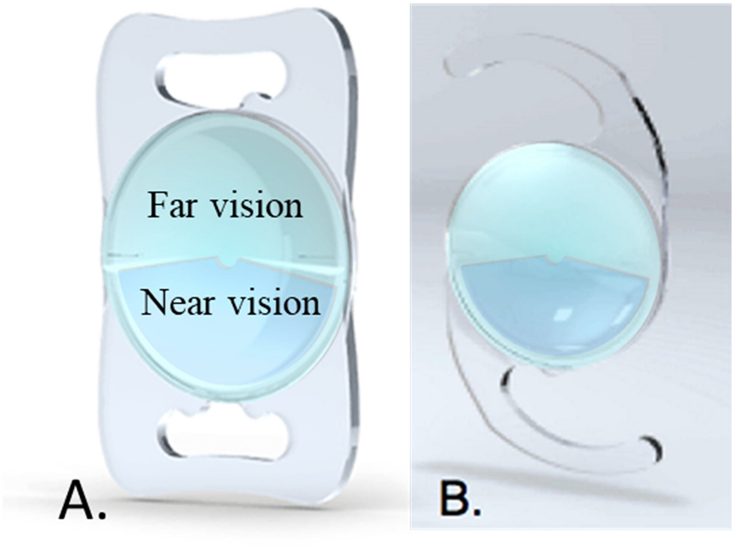 New method to improve the quality of vision in cataractous keratoconus eyes  | Scientific Reports