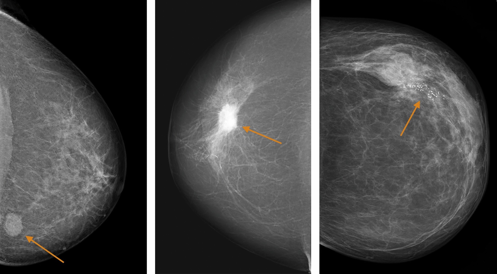 A) Bilateral medio-lateral mammograms revealed asymmetric breast