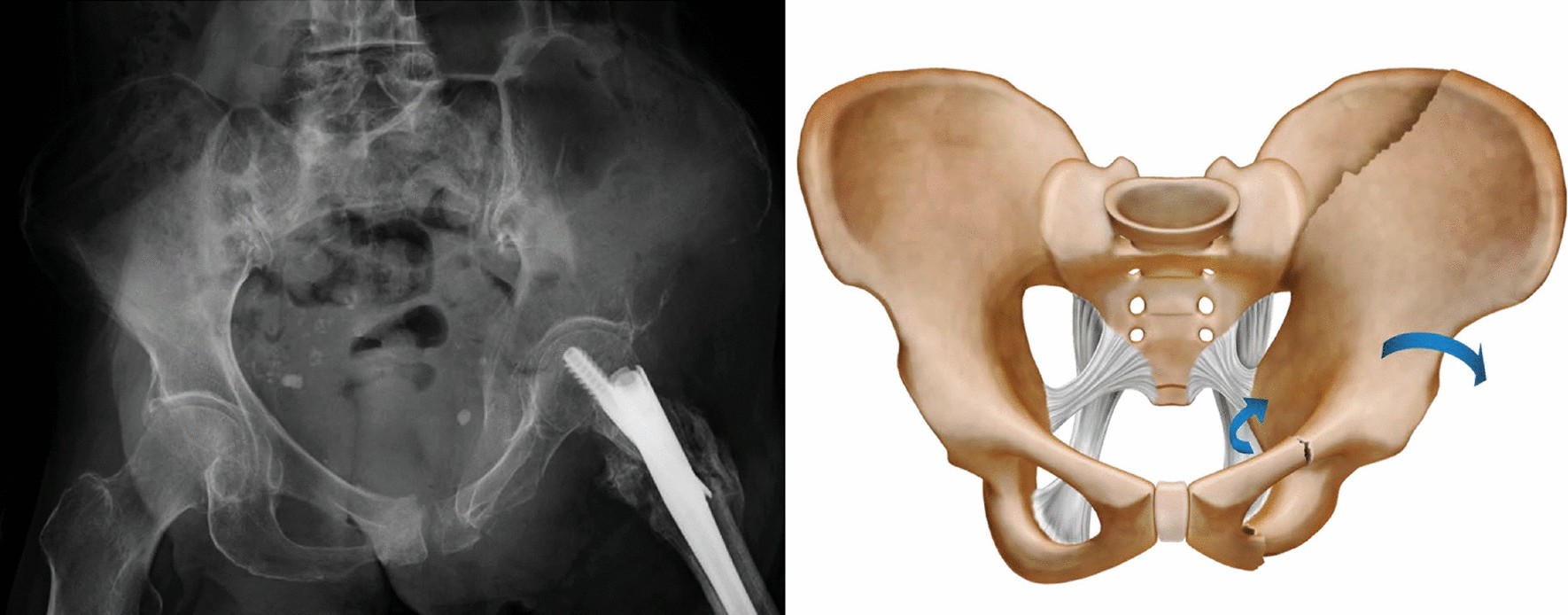Posterior Pelvic Ring Fractures of the SI Joint and the Sacrum - Ortho  Illinois
