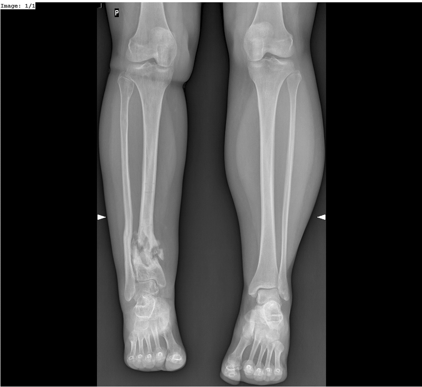 A Novel technique of three-ring Ilizarov fixator frame in gap non-union of  tibia - ScienceDirect