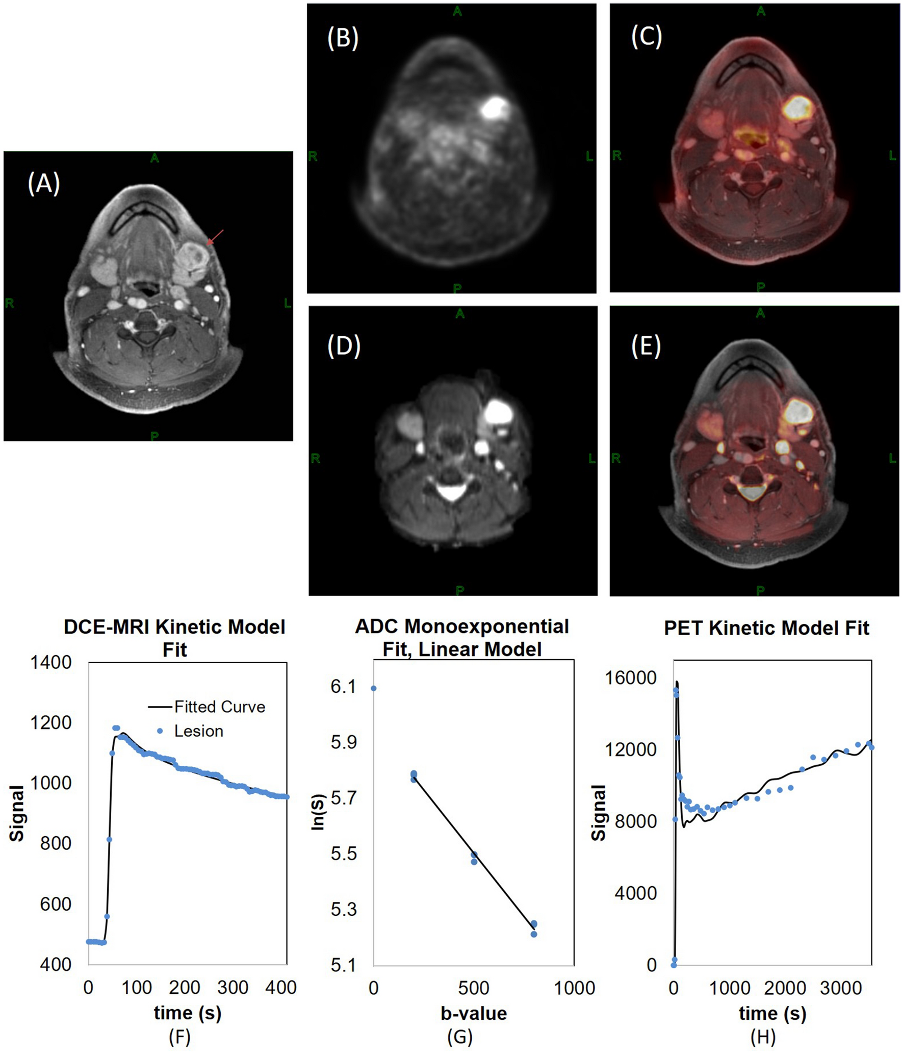 Assessment of metastatic lymph nodes in and neck cell carcinomas using simultaneous 18F-FDG-PET and MRI | Scientific Reports