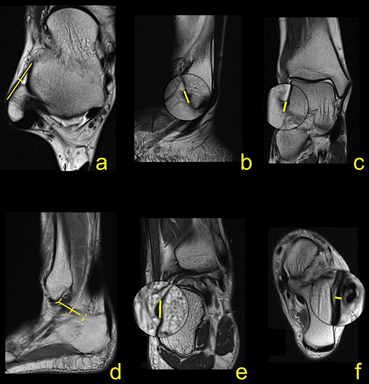The double fascicular variations of the anterior talofibular ligament and  the calcaneofibular ligament correlate with interconnections between  lateral ankle structures revealed on magnetic resonance imaging |  Scientific Reports