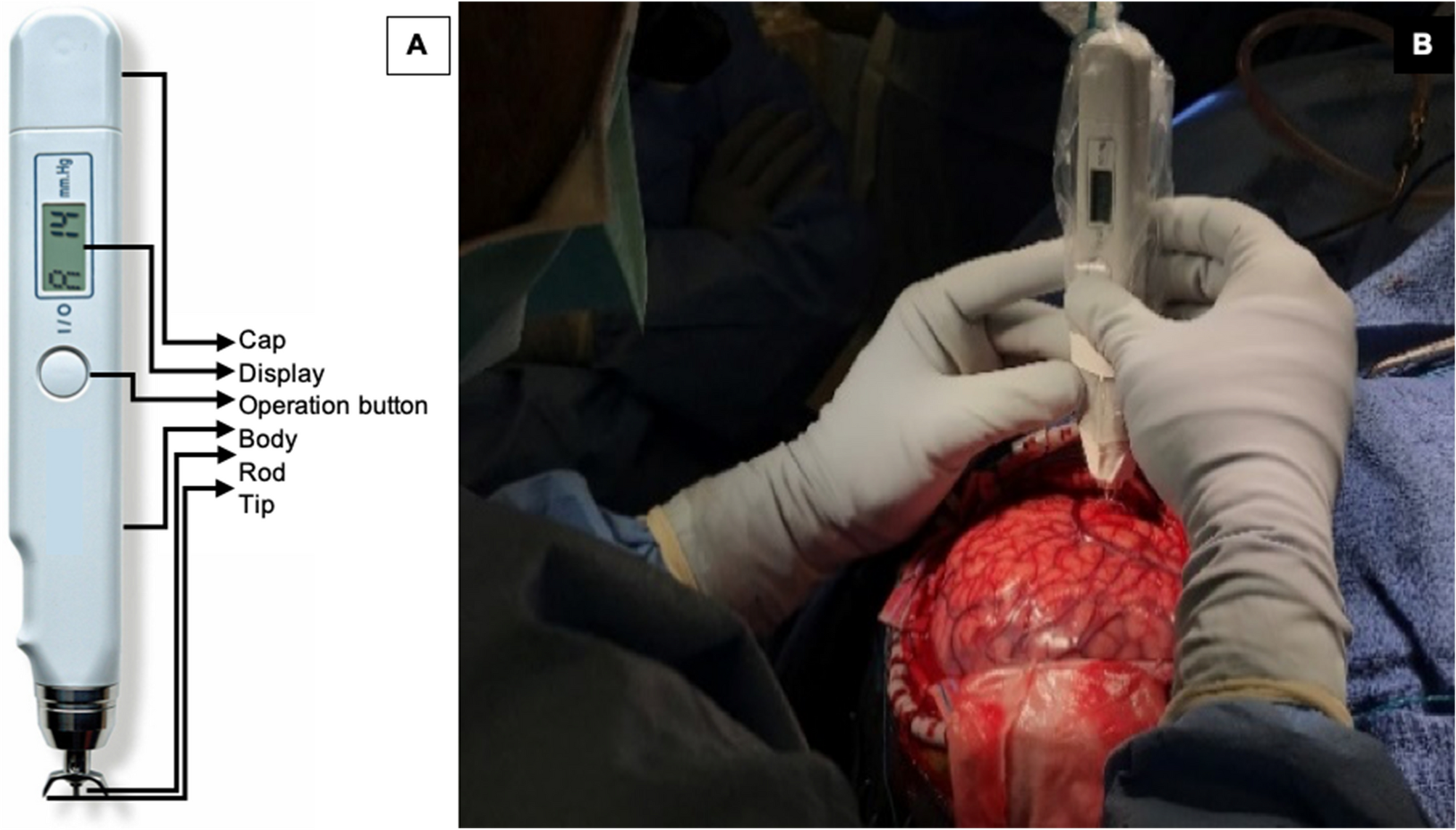 Novel tonometer device distinguishes brain stiffness in epilepsy surgery |  Scientific Reports