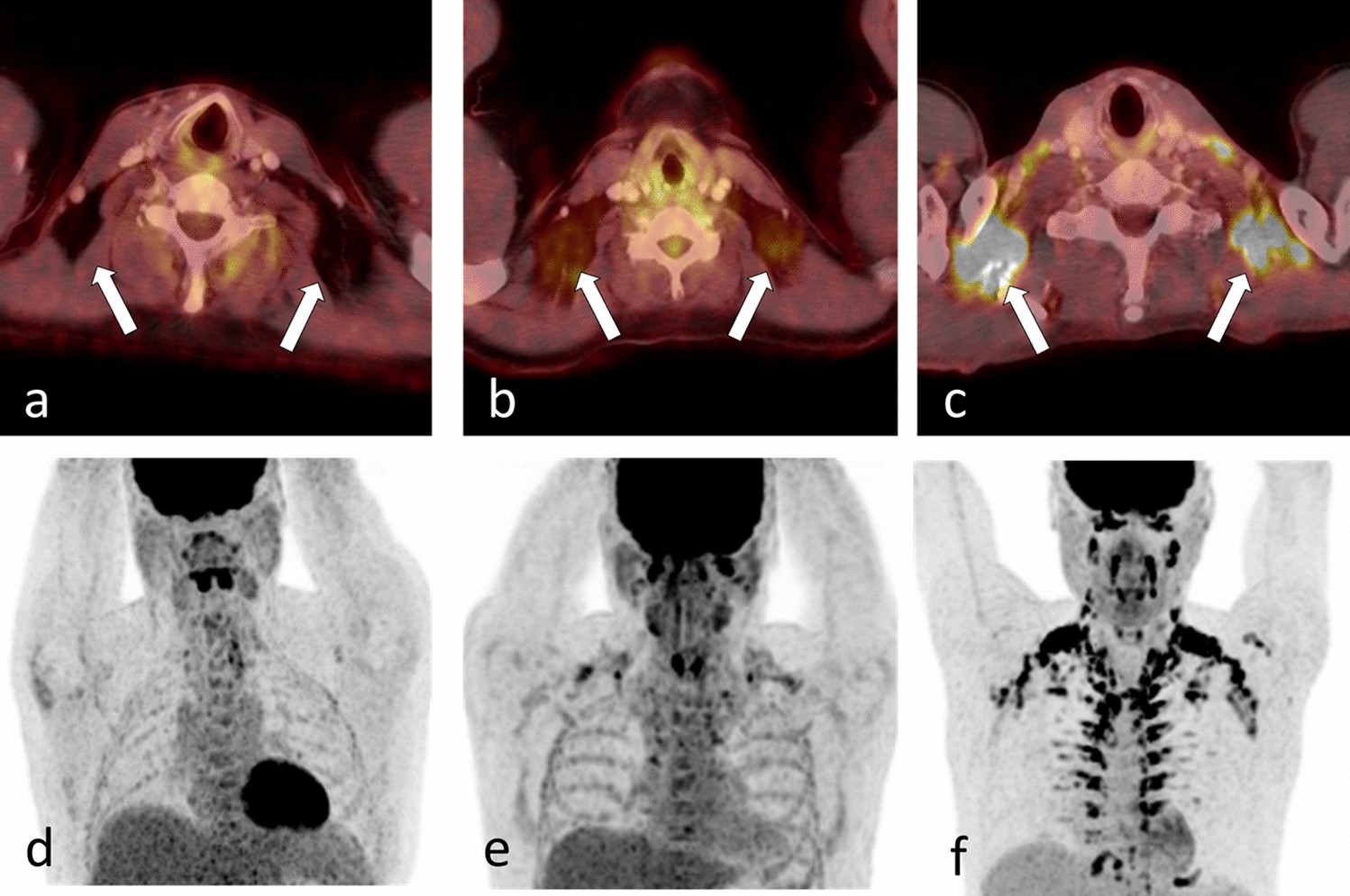 Associations of brown adipose tissue (BAT) 18 F-FDG activity after a