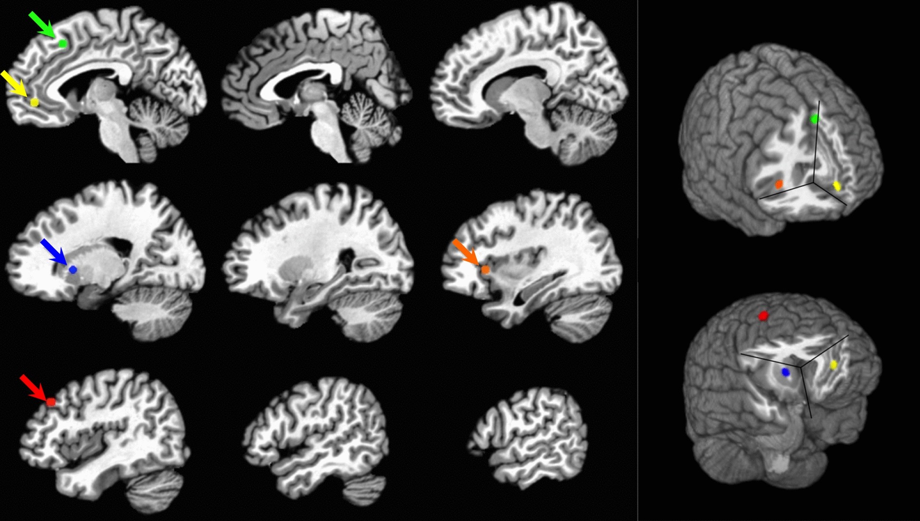 Using Functional Connectivity Changes Associated With Cognitive Fatigue To Delineate A Fatigue Network Scientific Reports Using Functional Connectivity Changes Associated With Cognitive Fatigue To Delineate A Fatigue Network Scientific Reports