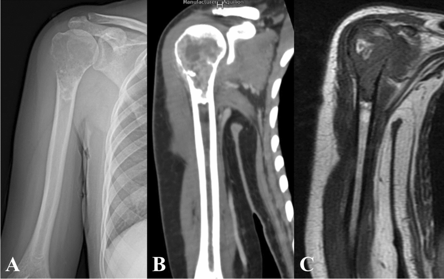 Mesh patch and anchors can improve clinical results of prosthetic