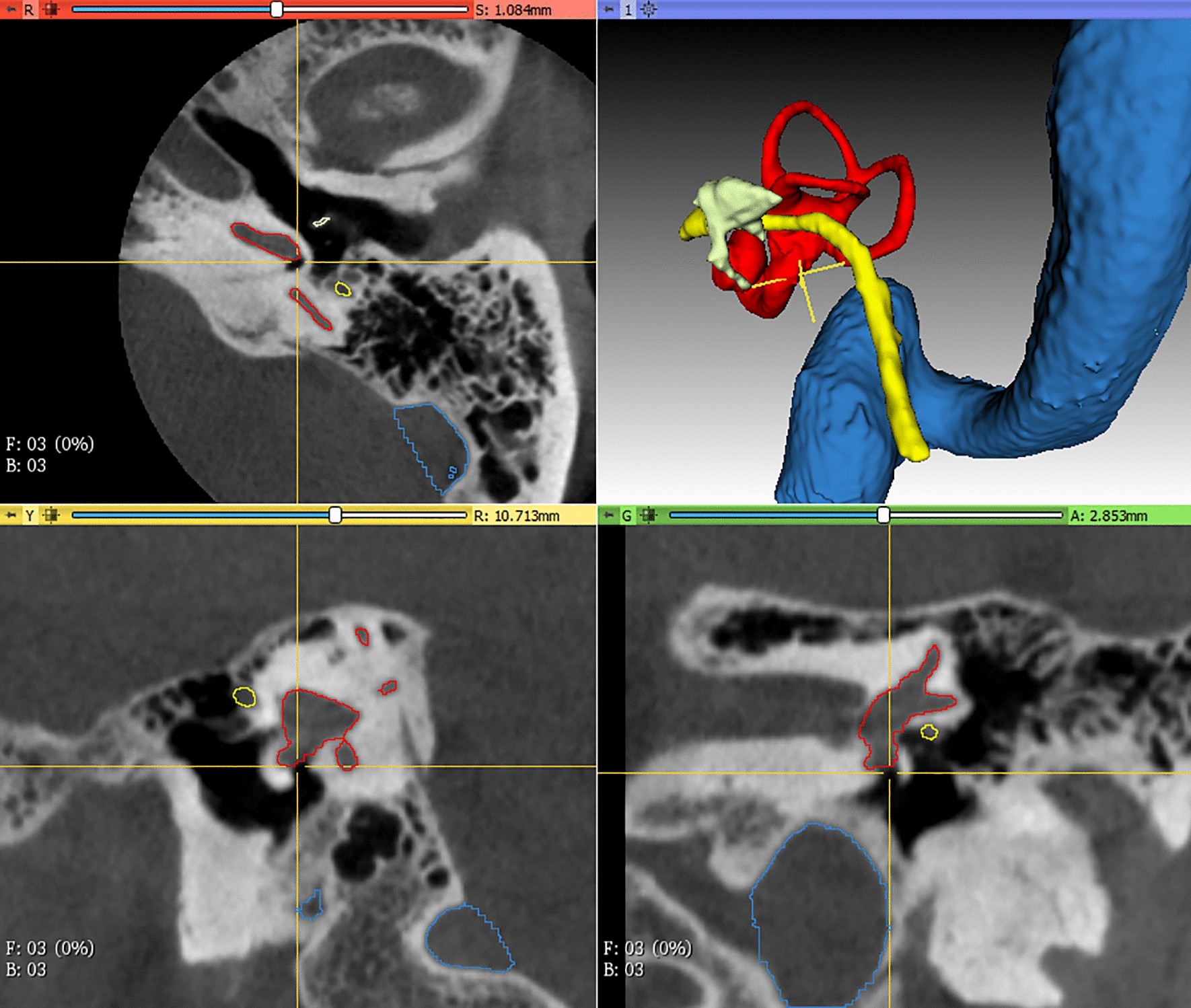 Middle Ear & Mastoid – Oto Surgery Atlas