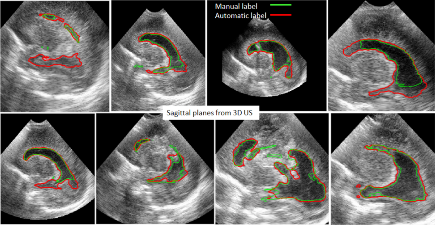 Automatic Segmentation Of Ventricular Volume By 3d Ultrasonography In Post Haemorrhagic Ventricular Dilatation Among Preterm Infants Scientific Reports
