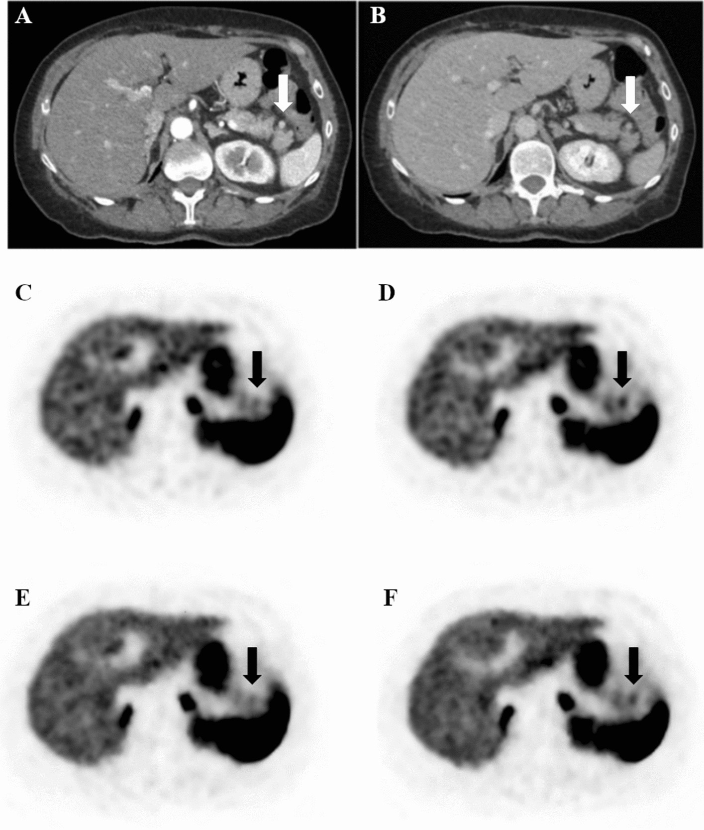 Impact of PET data driven respiratory motion correction and BSREM  reconstruction of 68Ga-DOTATATE PET/CT for differentiating neuroendocrine  tumors (NET) and intrapancreatic accessory spleens (IPAS) | Scientific  Reports
