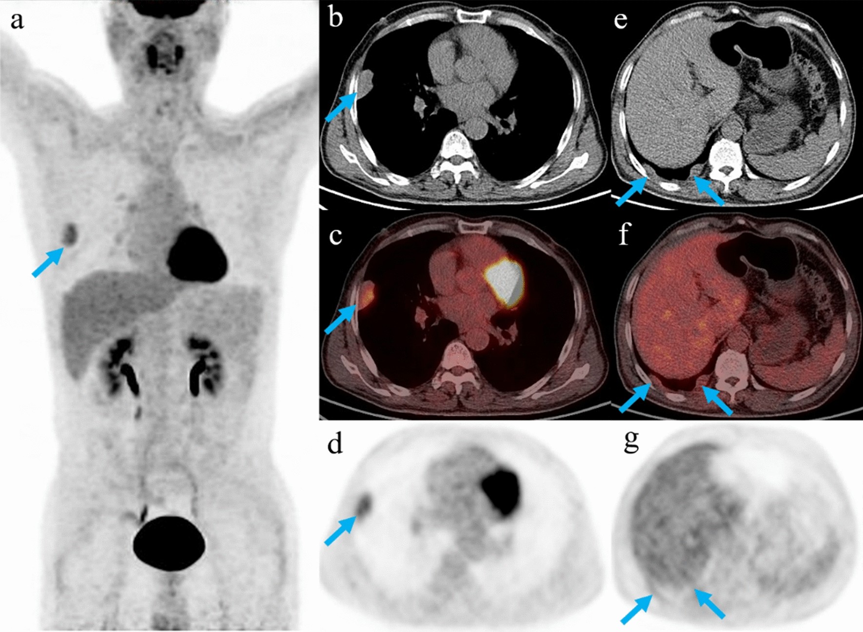 Diagnostic and prognostic value PET-CT in patients with suspected recurrent thymic epithelial tumors Scientific Reports