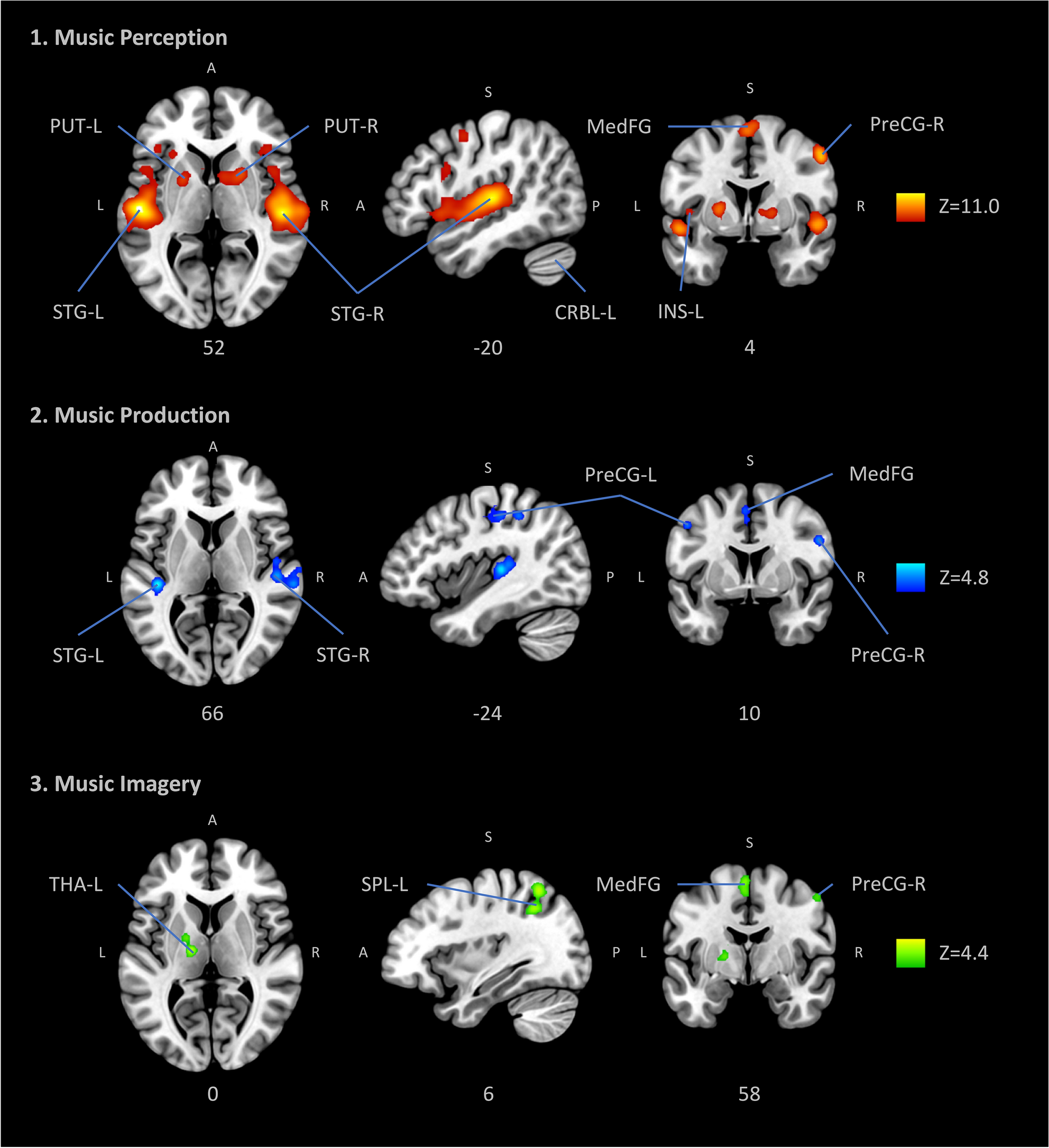 An ALE meta-analytic review of top-down and bottom-up processing of music  in the brain | Scientific Reports