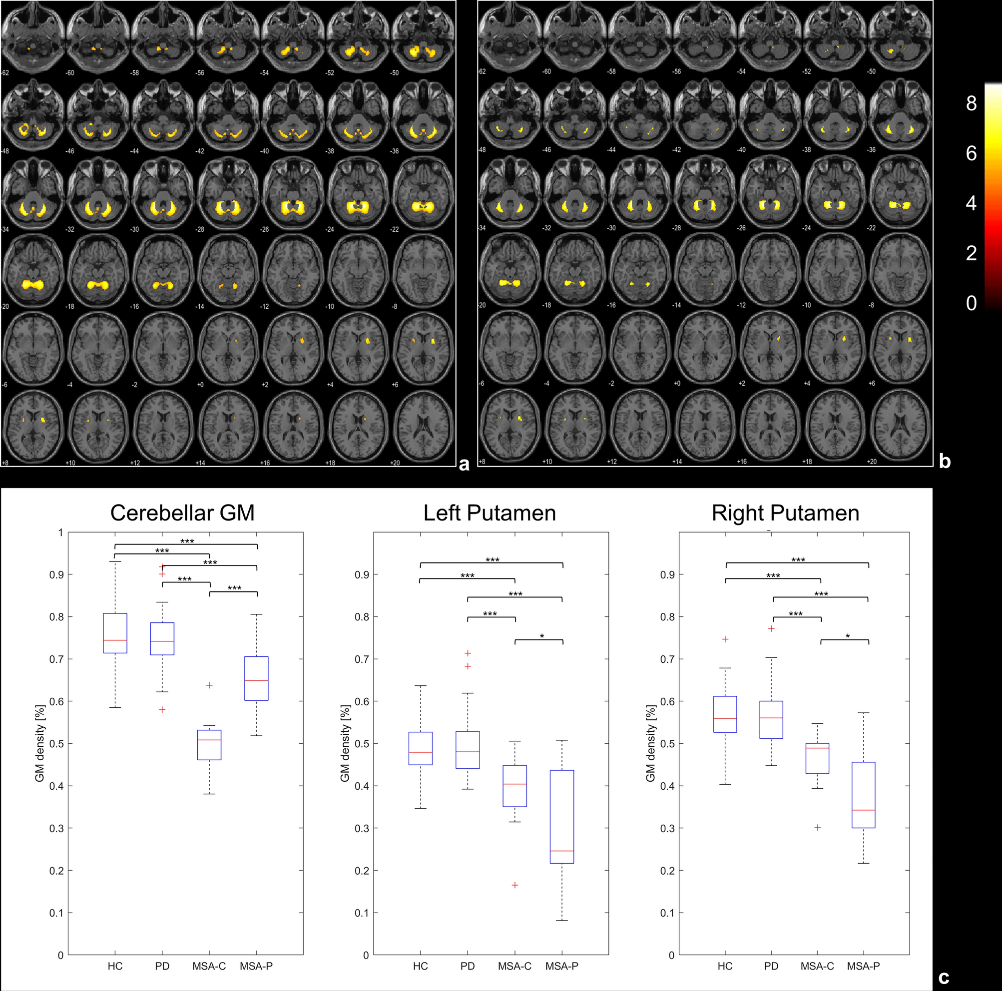 Magnetic resonance T1w/T2w ratio and voxel-based morphometry in multiple  system atrophy | Scientific Reports