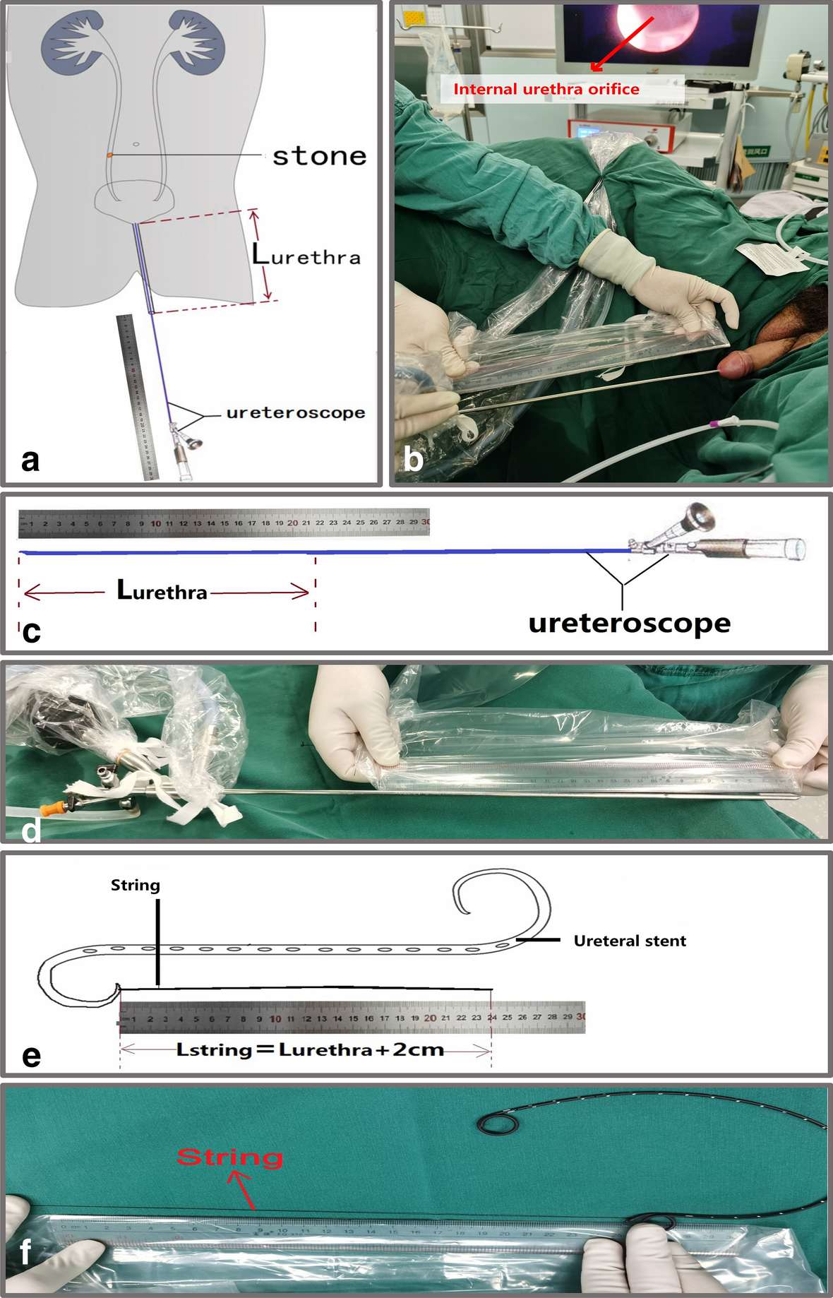 Novel method to decrease the exposure time of the extraction string of the  ureteral stent and its efficiency and safety verification in the clinic |  Scientific Reports