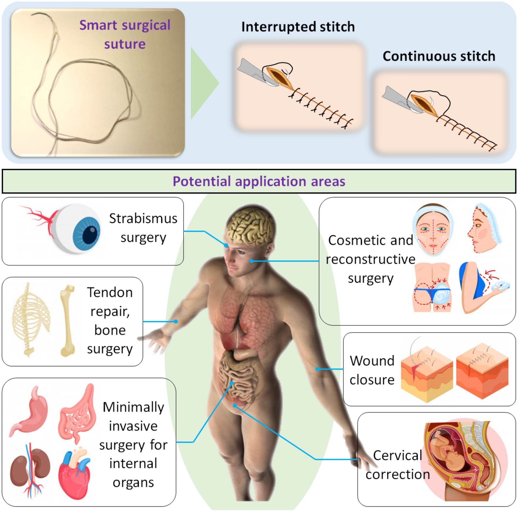 Smart surgical sutures using soft artificial muscles