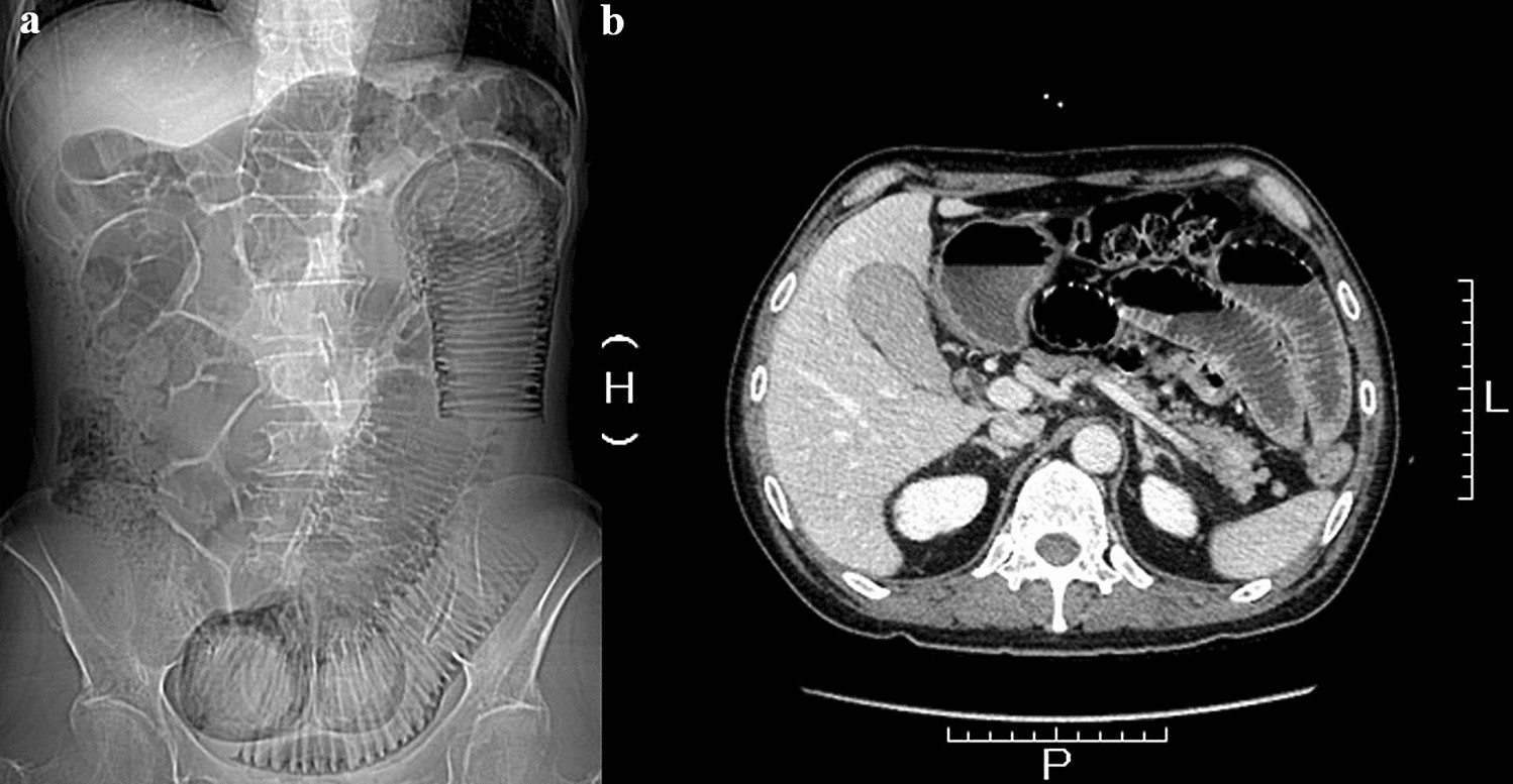 New cine magnetic resonance imaging parameters for the differential  diagnosis of chronic intestinal pseudo-obstruction | Scientific Reports