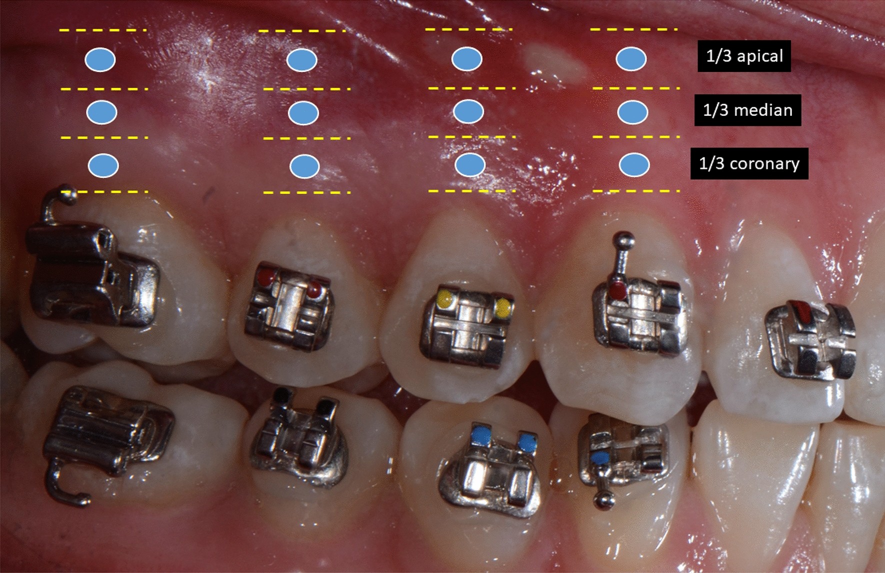 Effect of 970 nm low-level laser therapy on orthodontic tooth movement  during Class II intermaxillary elastics treatment: a RCT | Scientific  Reports