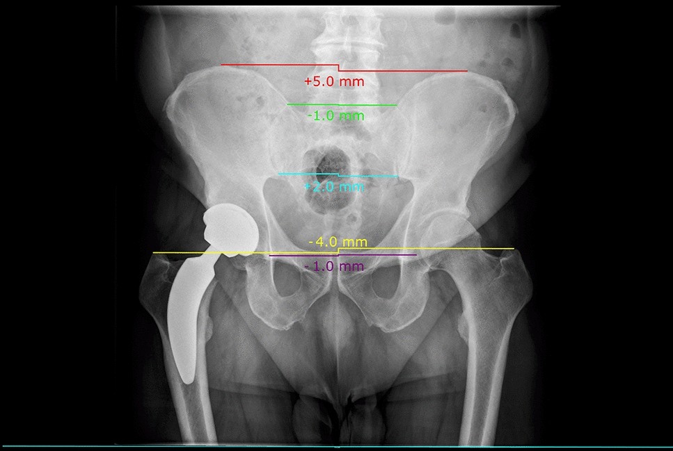Leg Length Measures Appear Inaccurate In The Early Phase Following Total Hip  Arthroplasty | Scientific Reports