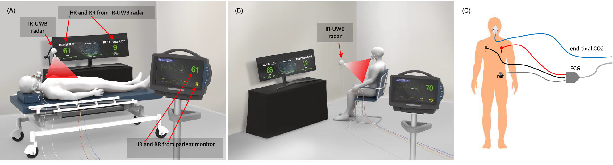 Preclinical evaluation of noncontact vital signs monitoring using real-time  IR-UWB radar and factors affecting its accuracy | Scientific Reports